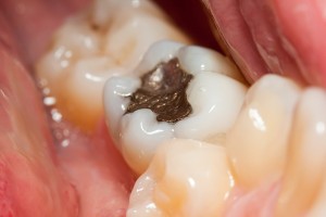 Why you should know more about cavities?